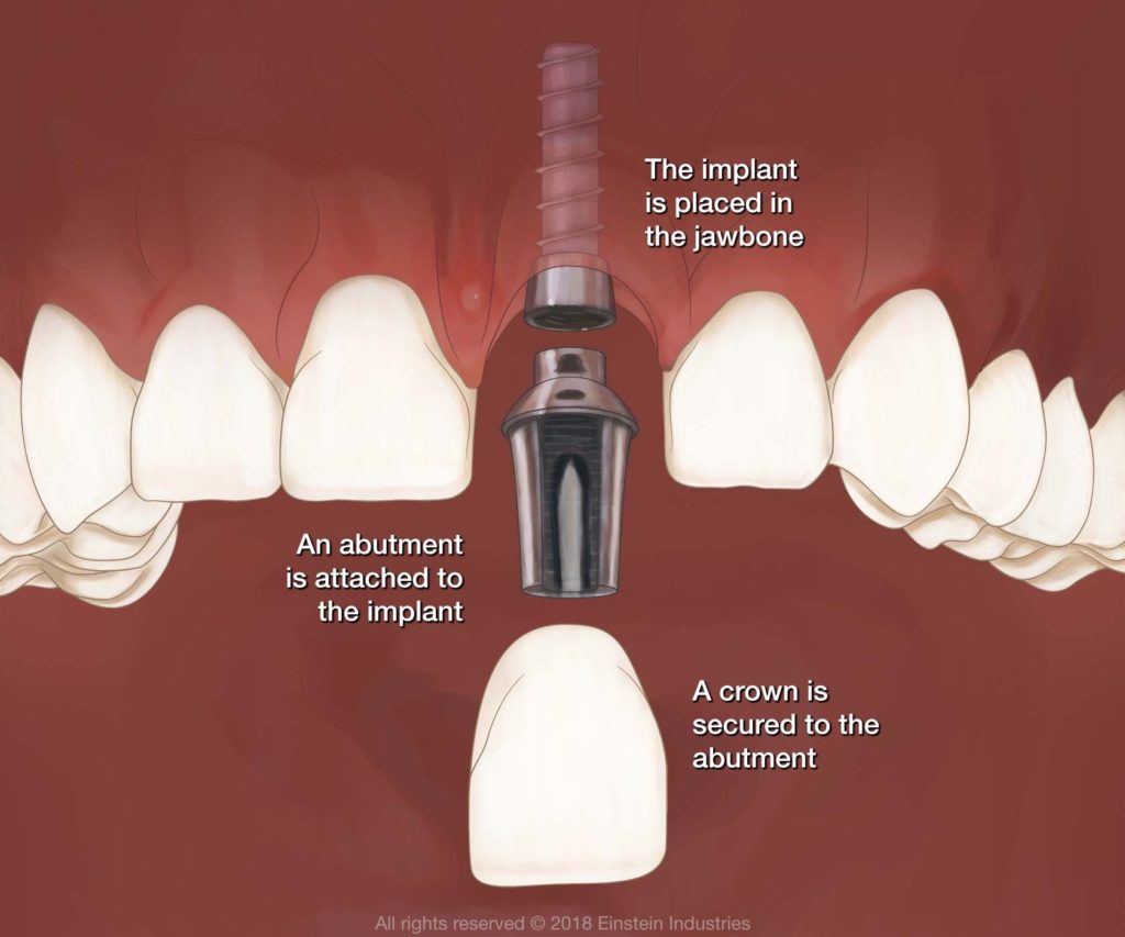 Dental Implant Parts